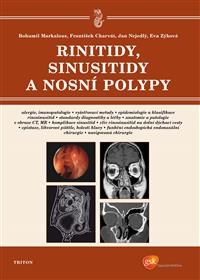 Rinitidy, sinusitidy a nosní polypy